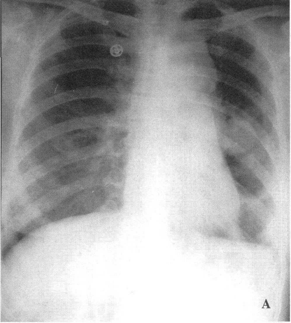 图2—213 肺鳞状细胞癌